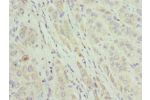 Immunohistochemistry of paraffin-embedded human liver cancer using CSB-PA738750ESR1HU at dilution 1:100
