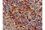 Immunohistochemistry of paraffin-embedded human pancreatic cancer using CSB-PA741052LA01HU at dilution of 1:100
