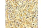 Immunohistochemistry of paraffin-embedded human lung cancer using CSB-PA741070LA01HU at dilution of 1:100