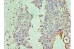 Immunohistochemistry of paraffin-embedded human endometrial cancer using CSB-PA744278ESR1HU at dilution 1:100