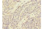Immunohistochemistry of paraffin-embedded human ovarian cancer CSB-PA745871ESR2HU at dilution 1:100