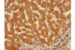 Immunohistochemistry of paraffin-embedded human liver cancer using CSB-PA747625LA01HU at dilution of 1:100