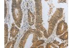 The image on the left is immunohistochemistry of paraffin-embedded Human colon cancer tissue using CSB-PA747689(DNAJC7 Antibody) at dilution 1/25, on the right is treated with fusion protein. (Original magnification: 