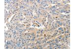 The image on the left is immunohistochemistry of paraffin-embedded Human ovarian cancer tissue using CSB-PA748239(CD93 Antibody) at dilution 1/60, on the right is treated with synthetic peptide. (Original magnification: 