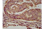 IHC image of CSB-PA748723LA01HU diluted at 1:200 and staining in paraffin-embedded human endometrial cancer performed on a Leica BondTM system. After dewaxing and hydration, antigen retrieval was mediated by high pressure in a citrate buffer (pH 6.0). Sec