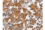 The image on the left is immunohistochemistry of paraffin-embedded Human thyroid cancer tissue using CSB-PA749878(COPB1 Antibody) at dilution 1/30, on the right is treated with fusion protein. (Original magnification: 