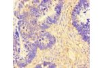 Immunohistochemistry of paraffin-embedded human ovarian cancer using CSB-PA750765LA01HU at dilution of 1:100