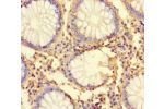 Immunohistochemistry of paraffin-embedded human colon cancer using CSB-PA750774HA01HU at dilution of 1:100