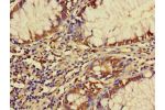 Immunohistochemistry of paraffin-embedded human colon cancer using CSB-PA751062LA01HU at dilution 1:100