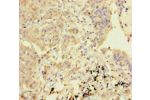 Immunohistochemistry of paraffin-embedded human lung cancer using CSB-PA751154LA01HU at dilution of 1:100