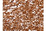 The image on the left is immunohistochemistry of paraffin-embedded Human thyroid cancer tissue using CSB-PA752513(FUT1 Antibody) at dilution 1/30, on the right is treated with synthetic peptide. (Original magnification: 