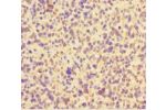 Immunohistochemistry of paraffin-embedded human glioma cancer using CSB-PA754170LA01HU at dilution 1:100