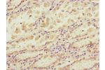 Immunohistochemistry of paraffin-embedded human gastric cancer using CSB-PA754307ESR1HU at dilution of 1:100