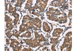 The image on the left is immunohistochemistry of paraffin-embedded Human breast cancer tissue using CSB-PA755352(ELP3 Antibody) at dilution 1/35, on the right is treated with synthetic peptide. (Original magnification: 