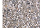 The image on the left is immunohistochemistry of paraffin-embedded Human liver cancer tissue using CSB-PA756613(DTNB Antibody) at dilution 1/50, on the right is treated with fusion protein. (Original magnification: 