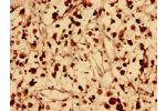 Immunohistochemistry analysis of human melanoma cancer using CSB-PA757601LA01HU at dilution of 1:100