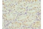 Immunohistochemistry of paraffin-embedded human gastric cancer using CSB-PA757939ESR1HU at dilution 1:100