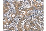 The image on the left is immunohistochemistry of paraffin-embedded Human gastic cancer tissue using CSB-PA758098(CR2 Antibody) at dilution 1/30, on the right is treated with synthetic peptide. (Original magnification: 