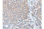 The image on the left is immunohistochemistry of paraffin-embedded Human liver cancer tissue using CSB-PA760706(ADAM20 Antibody) at dilution 1/50, on the right is treated with fusion protein. (Original magnification: 