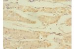 Immunohistochemistry of paraffin-embedded human gastric cancer CSB-PA760708LA01HU at dilution 1:100