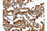 The image on the left is immunohistochemistry of paraffin-embedded Human thyroid cancer tissue using CSB-PA761300(DEFA4 Antibody) at dilution 1/40, on the right is treated with synthetic peptide. (Original magnification: 