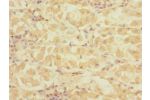 Immunohistochemistry of paraffin-embedded human gastric cancer using CSB-PA762572ESR1HU at dilution 1:100