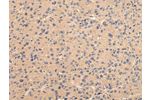 The image on the left is immunohistochemistry of paraffin-embedded Human liver cancer tissue using CSB-PA763132(BMP4 Antibody) at dilution 1/25, on the right is treated with fusion protein. (Original magnification: 