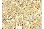 Immunohistochemistry of paraffin-embedded human lung cancer using CSB-PA768236LA01HU at dilution 1:100