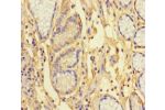 Immunohistochemistry of paraffin-embedded human gastric cancer using CSB-PA768761LA01HU at dilution of 1:100