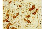 IHC image of CSB-PA769770LA01HU diluted at 1:800 and staining in paraffin-embedded human breast cancer performed on a Leica BondTM system. After dewaxing and hydration, antigen retrieval was mediated by high pressure in a citrate buffer (pH 6.0). Section 