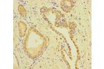 Immunohistochemistry of paraffin-embedded human prostate cancer using CSB-PA770346LA01HU at dilution of 1:100