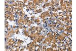 The image on the left is immunohistochemistry of paraffin-embedded Human thyroid cancer tissue using CSB-PA773682(CDK5RAP3 Antibody) at dilution 1/60, on the right is treated with fusion protein. (Original magnification: 