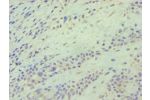 Immunohistochemistry of paraffin-embedded human breast cancer using CSB-PA773782ESR1HU at dilution 1:100