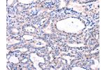 The image on the left is immunohistochemistry of paraffin-embedded Human thyroid cancer tissue using CSB-PA774733(DUSP12 Antibody) at dilution 1/77, on the right is treated with fusion protein. (Original magnification: 