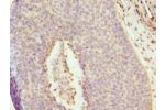 Immunohistochemistry of paraffin-embedded human cervical cancer using CSB-PA774794ESR2HU at dilution 1:100