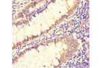 Immunohistochemistry of paraffin-embedded human colon cancer using CSB-PA774794LA01HU at dilution 1:100