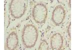 Immunohistochemistry of paraffin-embedded human colon cancer using CSB-PA774827LA01HU at dilution of 1:100