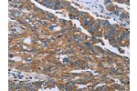 The image on the left is immunohistochemistry of paraffin-embedded Human ovarian cancer tissue using CSB-PA775340(GAB2 Antibody) at dilution 1/40, on the right is treated with fusion protein. (Original magnification: 