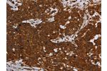 The image on the left is immunohistochemistry of paraffin-embedded Human cervical cancer tissue using CSB-PA775846(ERRFI1 Antibody) at dilution 1/30, on the right is treated with synthetic peptide. (Original magnification: 