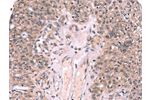 The image on the left is immunohistochemistry of paraffin-embedded Human ovarian cancer tissue using CSB-PA775997(EXTL1 Antibody) at dilution 1/20, on the right is treated with synthetic peptide. (Original magnification: 