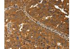 The image on the left is immunohistochemistry of paraffin-embedded Human ovarian cancer tissue using CSB-PA776176(AMD1 Antibody) at dilution 1/30, on the right is treated with synthetic peptide. (Original magnification: 