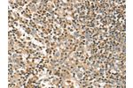 The image on the left is immunohistochemistry of paraffin-embedded Human tonsil tissue using CSB-PA776528(FMNL1 Antibody) at dilution 1/20, on the right is treated with fusion protein. (Original magnification: 