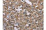 The image on the left is immunohistochemistry of paraffin-embedded Human thyroid cancer tissue using CSB-PA776568(GAB1 Antibody) at dilution 1/40, on the right is treated with fusion protein. (Original magnification: 