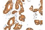 The image on the left is immunohistochemistry of paraffin-embedded Human colon cancer tissue using CSB-PA776608(ACOX1 Antibody) at dilution 1/40, on the right is treated with fusion protein. (Original magnification: 