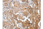 The image on the left is immunohistochemistry of paraffin-embedded Human lung cancer tissue using CSB-PA776767(ADA Antibody) at dilution 1/15, on the right is treated with fusion protein. (Original magnification: 