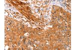 The image on the left is immunohistochemistry of paraffin-embedded Human cervical cancer tissue using CSB-PA777001(CNN3 Antibody) at dilution 1/15, on the right is treated with fusion protein. (Original magnification: 