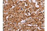 The image on the left is immunohistochemistry of paraffin-embedded Human thyroid cancer tissue using CSB-PA777238(CTNNBL1 Antibody) at dilution 1/50, on the right is treated with fusion protein. (Original magnification: 