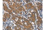 The image on the left is immunohistochemistry of paraffin-embedded Human gastic cancer tissue using CSB-PA777315(CLTC Antibody) at dilution 1/20, on the right is treated with synthetic peptide. (Original magnification: 