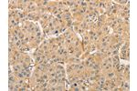 The image on the left is immunohistochemistry of paraffin-embedded Human liver cancer tissue using CSB-PA777675(ATG3 Antibody) at dilution 1/30, on the right is treated with fusion protein. (Original magnification: 