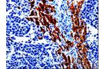 The image on the left is immunohistochemistry of paraffin-embedded Human liver cancer tissue using CSB-PA778097(EPHX1 Antibody) at dilution 1/20, on the right is treated with fusion protein. (Original magnification: 